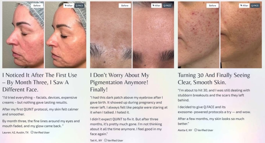 Supplied Q.Face before and after examples